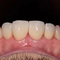 Close-up of healthy upper front teeth and gums with natural color and texture under bright lighting.