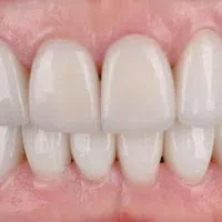 Close-up of bright white teeth showing healthy gums and perfect dental alignment in a natural smile