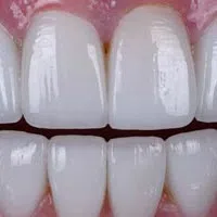 Close-up of bright white, healthy upper and lower human teeth with gums visible in natural lighting
