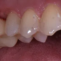 Close-up of upper teeth showing dental plaque, stains, and slight gum inflammation inside the mouth.
