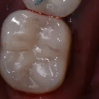 Close-up of a healthy molar tooth showing detailed grooves and smooth enamel surface under bright light.