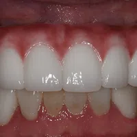 Close-up of teeth with upper dental veneers covering natural teeth, showing a contrast with lower stained teeth.