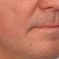 Close-up of a man's lower face showing skin texture, stubble, and neutral lip expression