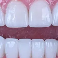 Close-up of clean, white upper and lower teeth with healthy pink gums and natural shine