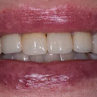 Close-up of a smile showing healthy, well-aligned teeth with natural pink lips.