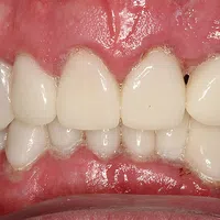 Close-up of human teeth with visible dental plaque and gum inflammation showing poor oral hygiene.