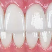 Close-up of bright, clean, white teeth with healthy pink gums and glossy enamel finish, showing a perfect smile.