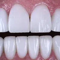 Close-up of a healthy set of white upper and lower human teeth with gums visible in a smile.