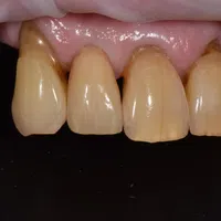 Close-up of upper front teeth with visible plaque, staining, and gum recession against a black background.