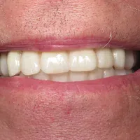 Close-up of a smiling mouth showing clean white teeth and natural lip texture.
