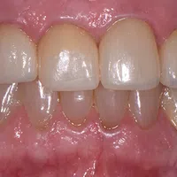 Close-up of upper and lower teeth with slight wear and natural staining on gums and enamel.