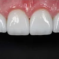 Close-up of a set of clean, white, evenly spaced upper front teeth with healthy pink gums.