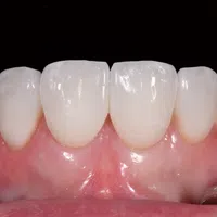 Close-up of healthy upper front teeth and gums with dental retractors exposing the gums and teeth.