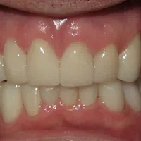 Close-up of dental veneers on upper and lower teeth showing natural color and alignment with gums.