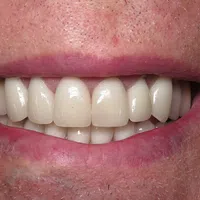 Close-up of a smiling mouth showing clean, white teeth and natural lip texture.