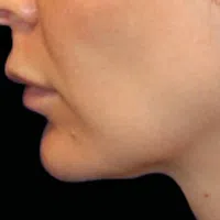 Close-up side view of a person's jawline and chin against a black background.