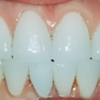 Close-up of clean, healthy white teeth and gums showing dental alignment and natural shine.