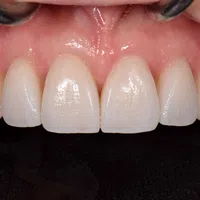 Close-up of healthy upper front teeth with clean gums and natural shine under dental examination.