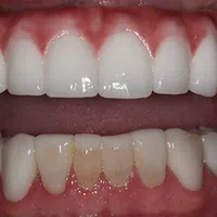 Close-up of upper dental veneers showcasing bright white teeth above natural, stained lower teeth.