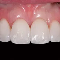 Close-up of healthy upper front teeth with natural gums and clean white enamel against black background.