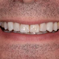Close-up of a man's smile showing clean, white teeth and facial stubble on lips and chin.
