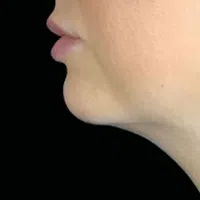 Close-up side profile of a person's lower face, nose, lips, and chin against a black background