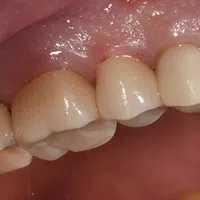 Close-up of molar teeth with dental crowns on lower jaw near gum line under bright light.