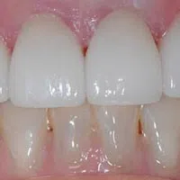 Close-up of upper and lower teeth showing dental alignment and gum health with slight discoloration on lower teeth.