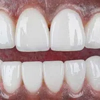 Close-up of bright white human teeth and gums with perfect dental alignment and healthy appearance