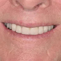 Close-up of a senior person's smile with white teeth and natural skin texture around lips and nose.