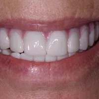 Close-up of a person's bright white smile showing clean, healthy teeth and pink gums.