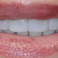 Close-up of lips with chapped skin and white teeth visible in a slight smile.