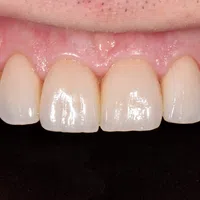 Close-up of clean, healthy upper front teeth and gums with natural shine and no visible dental issues.