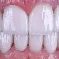 Close-up of clean, white teeth with healthy pink gums and natural shine in a smiling mouth.