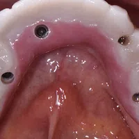 Close-up of dental implant-supported prosthesis fitted on upper jaw showing abutment screws and gums