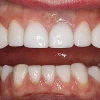 Close-up of an open mouth showing upper dental crowns and natural lower teeth with gum detail.
