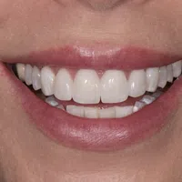 Close-up of a smiling mouth showing clean, white teeth with natural lips and skin texture.