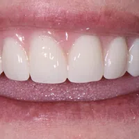 Close-up of a bright, even smile with clean, white teeth and healthy gums