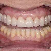 Close-up of a mouth showing white upper dental veneers and natural lower teeth with some discoloration.