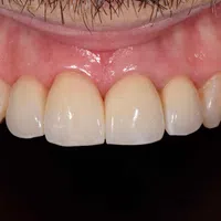 Close-up of healthy upper front teeth and gums with natural color and smooth texture.