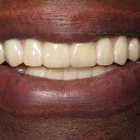 Close-up of a smiling mouth with clean, white teeth and dark skin tone lips.