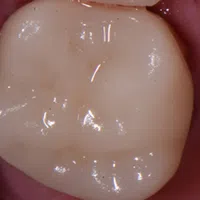 Close-up of a healthy molar tooth with detailed enamel surface in a human mouth.