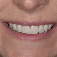 Close-up of a smiling mouth showing clean, white teeth and natural lips on a light skin tone.