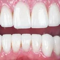 Close-up of healthy, clean upper and lower teeth with pink gums and bright white enamel.