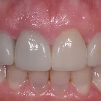 Close-up of upper and lower teeth with dental veneers showing natural and restored teeth.