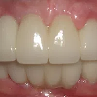 Close-up of healthy, white upper and lower teeth with natural gums in a bright smile.