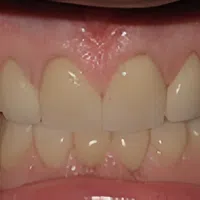 Close-up of a person's teeth showing dental alignment and gums in natural lighting.