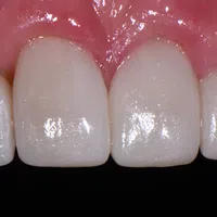 Close-up of white healthy front teeth and pink gums against a black background