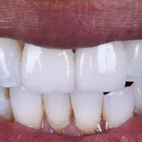 Close-up of a bright smile showing clean, white teeth and healthy pink lips.