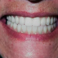 Close-up of a person's smile showing clean, white, evenly aligned teeth and lips.